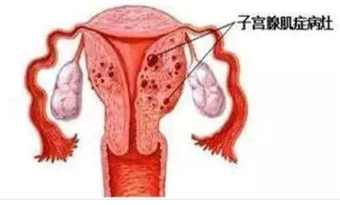 关于子宫腺肌病您了解多少？